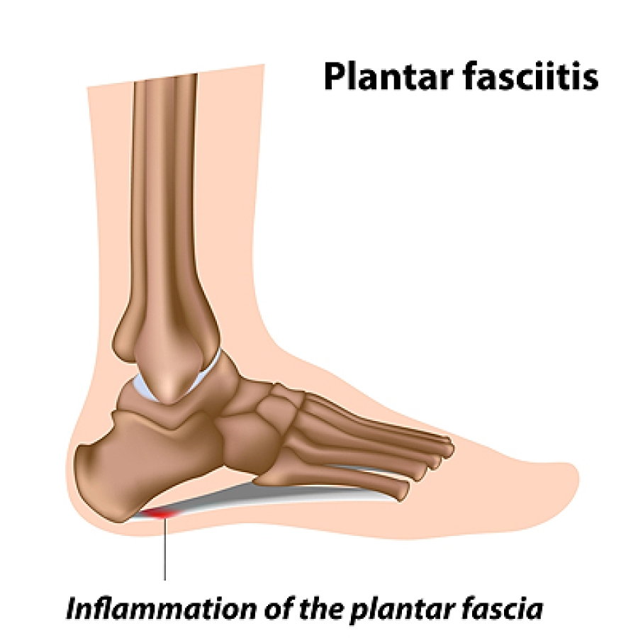 Plantar Fasciitis - Farnsworth Orthopedic Physical Therapy